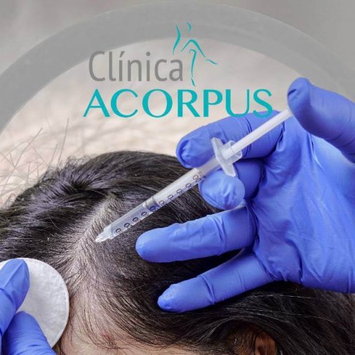 ALOPECIA TERAPIA ENDOVENOSA Acorpus