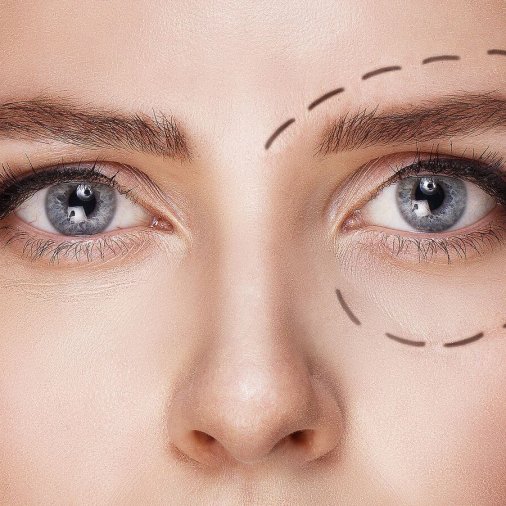 blefaroplastia