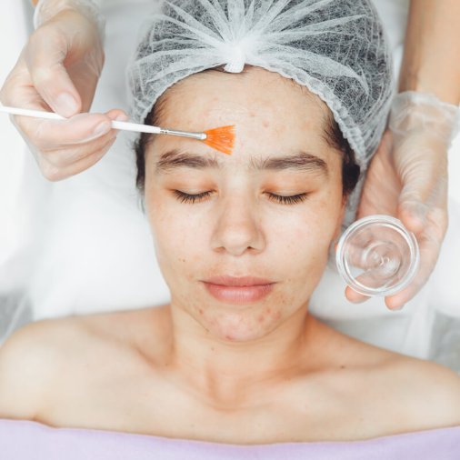 A cosmetologist does facial care and apply a face mask. cleansing a heavily soiled face. acne on the skin. skin rashes. mechanical face painting.